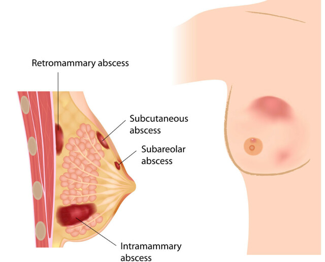 Brystbetennelse kreft Brystbetennelse kreft
