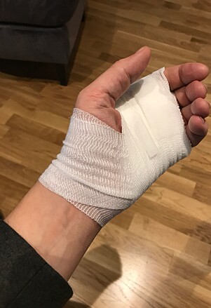FIKK HJELP: Slik så Tores hånd ut etter legebesøket. Foto: Privat FIKK HJELP: Slik så Tores hånd ut etter legebesøket. Foto: Privat