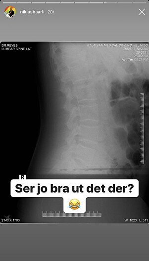 RØNTGEN: Radioprofilen delte to røntgenbilder av ryggen i påvente på svar. Foto: Skjermdump Instagram RØNTGEN: Radioprofilen delte to røntgenbilder av ryggen i påvente på svar. Foto: Skjermdump Instagram