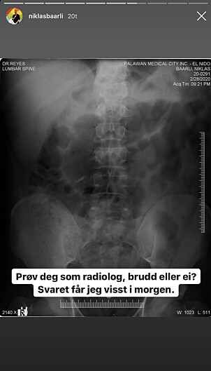 BRUDD?: Baarli spør om hjelp på Instagram for å finne ut om det er snakk om brudd i ryggen. Foto: Skjermdump Instagram BRUDD?: Baarli spør om hjelp på Instagram for å finne ut om det er snakk om brudd i ryggen. Foto: Skjermdump Instagram