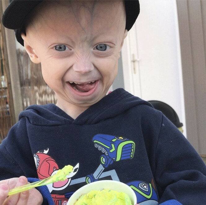 SJELDENT SYNDROM: Fem år gamle Luke har et sjeldent syndrom. Foto: Media Drum World SJELDENT SYNDROM: Fem år gamle Luke har et sjeldent syndrom. Foto: Media Drum World