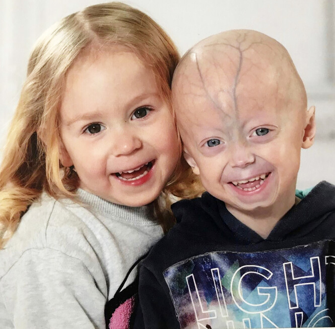 MINDRE ENN LILLESØSTER: Fem år gamle Luke veier bare i underkant av ti kilo, og er mye mindre enn lillesøster Lea - som er tre og et halvt år gammel. Foto: Media Drum World MINDRE ENN LILLESØSTER: Fem år gamle Luke veier bare i underkant av ti kilo, og er mye mindre enn lillesøster Lea - som er tre og et halvt år gammel. Foto: Media Drum World
