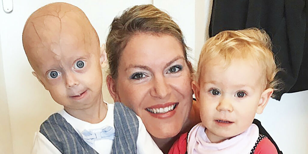 image: Luke (5) har kropp som en 50-åring