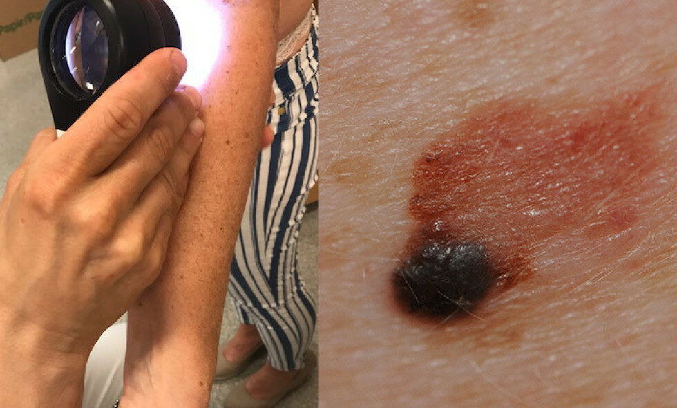 KREFT: Dette er et eksempel på malignt melanom, eller føflekkreft på folkemunne. Foto: Kreftforeningen. KREFT: Dette er et eksempel på malignt melanom, eller føflekkreft på folkemunne. Foto: Kreftforeningen.