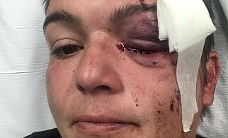 SKUTT: Linda Tirado la ut bilde av seg selv fra sykehussenga etter at hun ble skutt av politiet. Foto: Twitter SKUTT: Linda Tirado la ut bilde av seg selv fra sykehussenga etter at hun ble skutt av politiet. Foto: Twitter