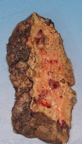 ØDELAGT LUNGE: Slik så den ødelagte lungen til coronapasienten ut. Legene ble rystet da de så hvor skadet lungen var. Foto: Northwestern Medicine / AFP ØDELAGT LUNGE: Slik så den ødelagte lungen til coronapasienten ut. Legene ble rystet da de så hvor skadet lungen var. Foto: Northwestern Medicine / AFP