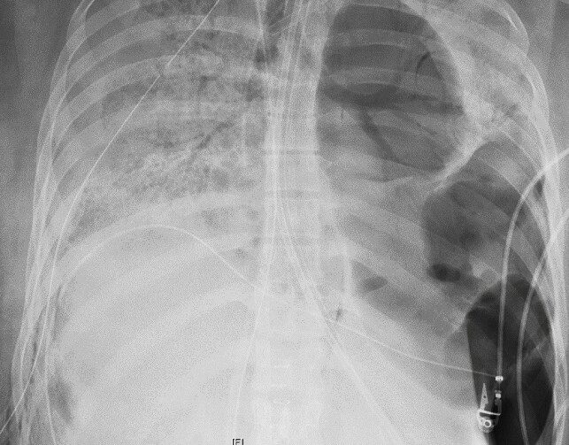 RØNTGEN: Et røntgenbilde viser brystet til covid-pasienten før hun fikk nye lunger. Foto: Northwestern Medicine via AP RØNTGEN: Et røntgenbilde viser brystet til covid-pasienten før hun fikk nye lunger. Foto: Northwestern Medicine via AP