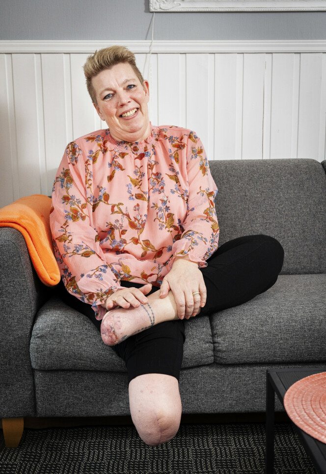 HELL I UHELL: Elin mistet halve høyrebeinet, men er lettet over at hun har det andre beinet i behold, selv om tærne måtte fjernes. – Det kunne vært mye verre, sier Holmestrand-kvinnen som ble smittet av en sykehusbakterie og fikk blodforgiftning. Foto: Espen Solli/Se og Hør HELL I UHELL: Elin mistet halve høyrebeinet, men er lettet over at hun har det andre beinet i behold, selv om tærne måtte fjernes. – Det kunne vært mye verre, sier Holmestrand-kvinnen som ble smittet av en sykehusbakterie og fikk blodforgiftning. Foto: Espen Solli/Se og Hør