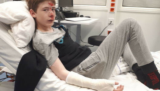 MEDTATT: Hjernerystelse, knekte tenner, bukket arm og en haug med skrubbsår var det Sander satt igjen med. Foto: Privat MEDTATT: Hjernerystelse, knekte tenner, bukket arm og en haug med skrubbsår var det Sander satt igjen med. Foto: Privat
