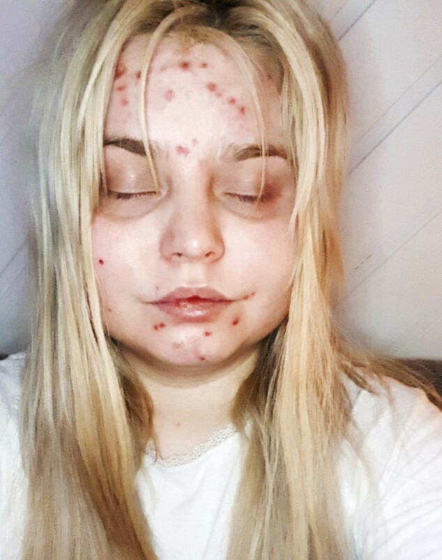 TØFF BEHANDLING:
Legene har forsøkt man-
ge medisiner i håp om at behandlingen ville gjøre Sarah frisk. Noen har medført store bivirkninger, som da hun kk ansiktet fullt av kviser. TØFF BEHANDLING:
Legene har forsøkt man-
ge medisiner i håp om at behandlingen ville gjøre Sarah frisk. Noen har medført store bivirkninger, som da hun kk ansiktet fullt av kviser.