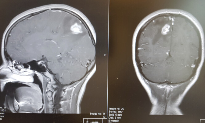 HVIT FLEKK: CT-bildene av hodet
til Sarah viser en hvit flekk inne i hjernen, men flekken er i bevegelse. Hun ble en stund behandlet med cellegift som om det skulle være en blodårebetennelse. HVIT FLEKK: CT-bildene av hodet
til Sarah viser en hvit flekk inne i hjernen, men flekken er i bevegelse. Hun ble en stund behandlet med cellegift som om det skulle være en blodårebetennelse.