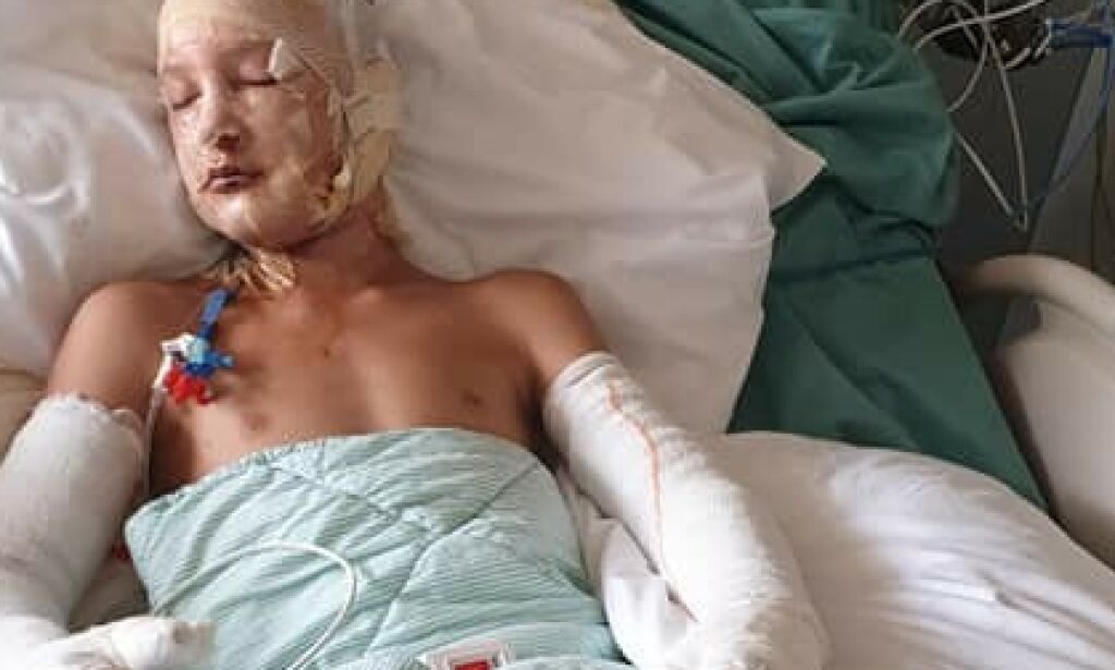 image: Noa (13) kraftig forbrent under livsfarlig lek