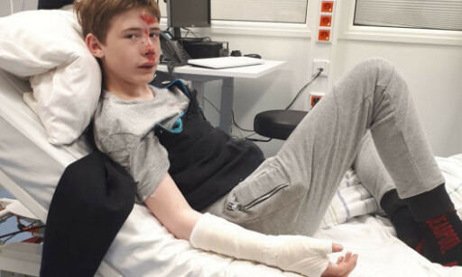 MEDTATT: Hjernerystelse, knekte tenner, bukket arm og en haug med skrubbsår var det Sander satt igjen med. Foto: Privat MEDTATT: Hjernerystelse, knekte tenner, bukket arm og en haug med skrubbsår var det Sander satt igjen med. Foto: Privat