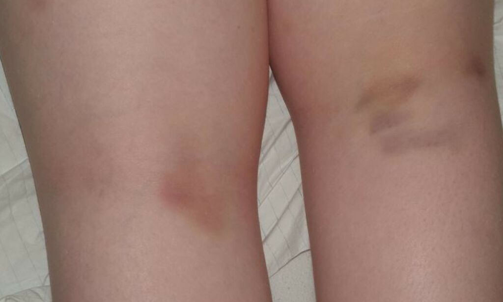 image: Fenja (9) etterlatt i badekar - brannskadd