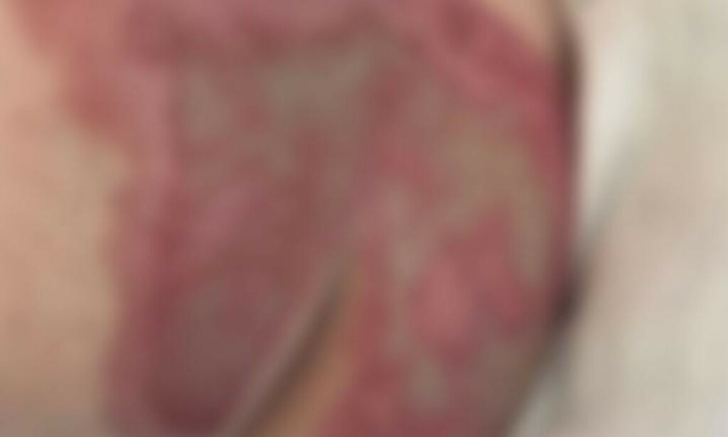 ANDREGRADSFORBRENNING: Slik så baken til Fenja ut etter badet. Dagbladet har sladdet bildet av hensyn til avbildede. Foto: Privat ANDREGRADSFORBRENNING: Slik så baken til Fenja ut etter badet. Dagbladet har sladdet bildet av hensyn til avbildede. Foto: Privat
