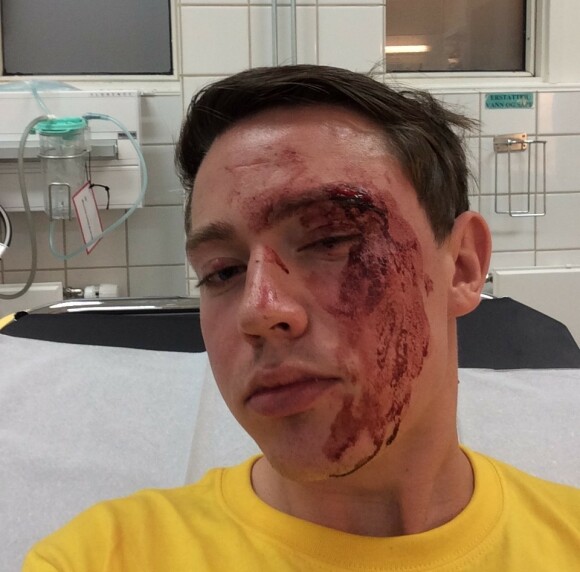 <strong>SKALLET NED:</strong> Slik så 22 år gamle Edvin Eriksen ut da han ankom legevakten etter å ha blitt skallet ned i Oslo. Foto: Privat <strong>SKALLET NED:</strong> Slik så 22 år gamle Edvin Eriksen ut da han ankom legevakten etter å ha blitt skallet ned i Oslo. Foto: Privat