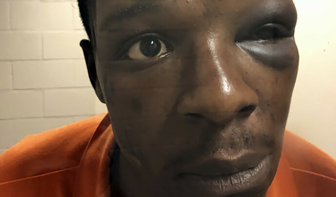 <strong>FORSLÅTT:</strong> Roderick Walker sitter i fengslet i Clayton County. Et bilde fra fengselet viser at han har store blåmerker. Foto: The Cochran Firm / AP / NTB scanpix <strong>FORSLÅTT:</strong> Roderick Walker sitter i fengslet i Clayton County. Et bilde fra fengselet viser at han har store blåmerker. Foto: The Cochran Firm / AP / NTB scanpix