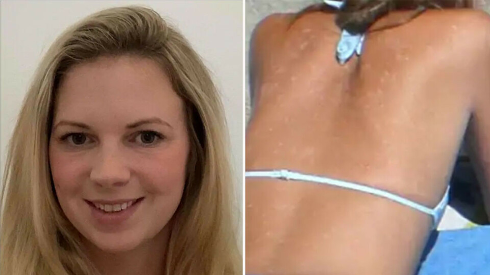 Sofia (29) ble kvitt psoriasisen etter en eneste sprøyte