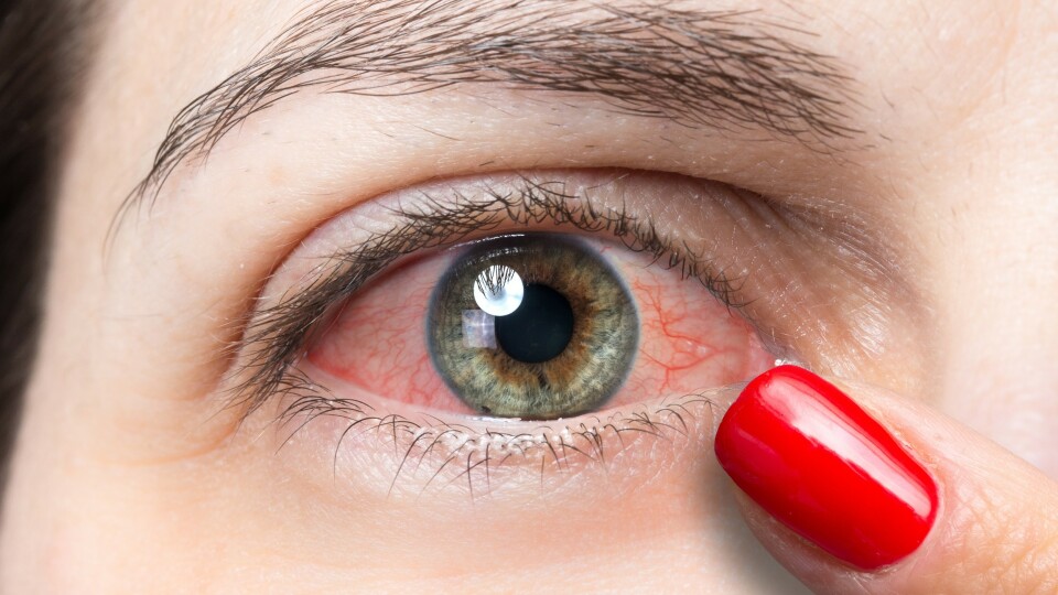 Øyelege: Supermetoden mot tørre øyne