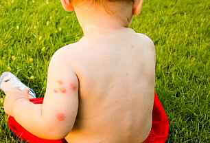 Allergisk reaksjon på myggstikk