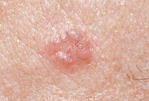 Basaliomer: Den vanligste formen for hudkreft