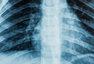 Røntgenstråling - hvor farlig er det egentlig?