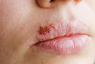Herpes simplex (munnsår)