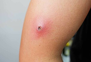 Hva er symptomer på infeksjon i sår?