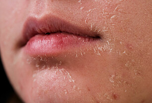 Hudlege: Dette hjelper ved tørr hud i ansiktet