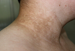 Acanthosis nigricans: Mørk hud i nakke og hudfolder