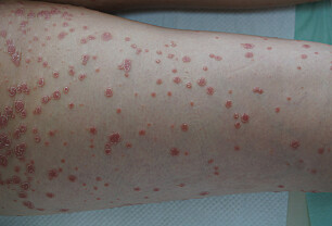 Røde prikker i huden. Hva kan være årsak?