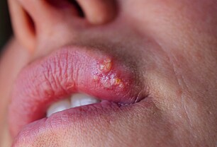 Hva er årsaken til herpes?