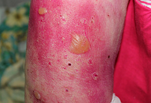 Bulløs pemfigoid er en autoimmun sykdom som gir blemmer